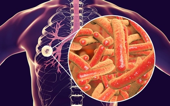 Image: The breakthrough approach for diagnosing TB could significantly improve detection (Photo courtesy of 123RF) Image: The breakthrough approach for diagnosing TB could significantly improve detection (Photo courtesy of 123RF)