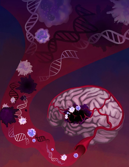 Image: Release of cell-free DNA and altered blood cells in patients with cancer (Photo courtesy of Carolyn Hruban/Johns Hopkins) Image: Release of cell-free DNA and altered blood cells in patients with cancer (Photo courtesy of Carolyn Hruban/Johns Hopkins)
