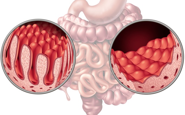 Image: Non-invasive methods could transform adult celiac disease diagnoses (Photo courtesy of Adobe Stock) Image: Non-invasive methods could transform adult celiac disease diagnoses (Photo courtesy of Adobe Stock)