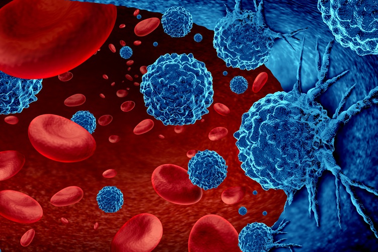 Image: A blood test for many cancers could potentially thwart progression to late stage in up to half of cases (Photo courtesy of Shutterstock) Image: A blood test for many cancers could potentially thwart progression to late stage in up to half of cases (Photo courtesy of Shutterstock)