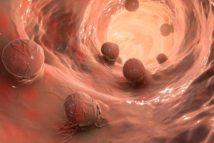 Image: The new study aims to enhance colorectal cancer prevention by identifying polyp molecular signals (Photo courtesy of Shutterstock) Image: The new study aims to enhance colorectal cancer prevention by identifying polyp molecular signals (Photo courtesy of Shutterstock)