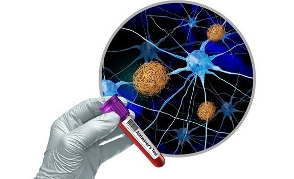 Image: Brain biomarkers of Alzheimer\'s disease can be detected as early as middle age (Photo courtesy of University of Shutterstock) Image: Brain biomarkers of Alzheimer\'s disease can be detected as early as middle age (Photo courtesy of University of Shutterstock)