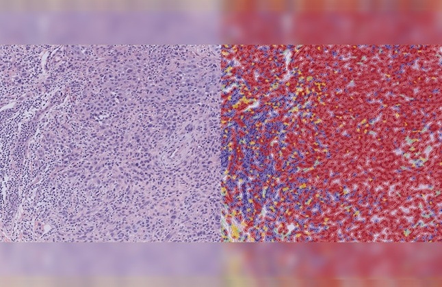 Image: Stained melanoma tissue image before (left) and after (right) AI algorithm application (Photo courtesy of Yale) Image: Stained melanoma tissue image before (left) and after (right) AI algorithm application (Photo courtesy of Yale)