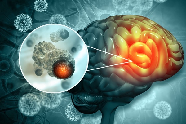 Image: The genetic biomarker can help identify glioblastoma patients who are most likely to benefit from bevacizumab (Photo courtesy of 123RF) Image: The genetic biomarker can help identify glioblastoma patients who are most likely to benefit from bevacizumab (Photo courtesy of 123RF)