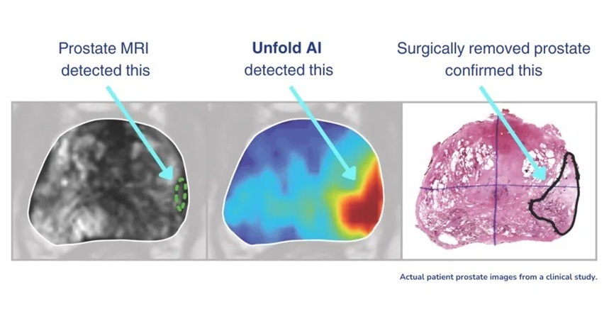 Image: Unfold AI is the first and only FDA-cleared prostate cancer analysis and visualization platform (Photo courtesy of Avenda Health) Image: Unfold AI is the first and only FDA-cleared prostate cancer analysis and visualization platform (Photo courtesy of Avenda Health)