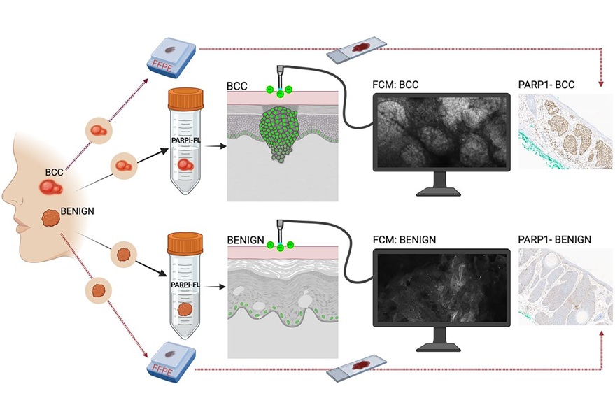 Image: PARPi-FL fluorescent confocal microscopy imaging for basal cell carcinoma detection. (Photo courtesy of Manu Jain and Ashish Dhir/MSK) Image: PARPi-FL fluorescent confocal microscopy imaging for basal cell carcinoma detection. (Photo courtesy of Manu Jain and Ashish Dhir/MSK)