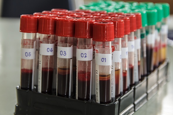 Image: The dual blood biomarker strategy will improve early ALS diagnosis (Photo courtesy of 123RF)