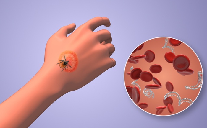 Image: The test detects Lyme-causing bacteria with far greater sensitivity than standard tests (Photo courtesy of Shutterstock) Image: The test detects Lyme-causing bacteria with far greater sensitivity than standard tests (Photo courtesy of Shutterstock)