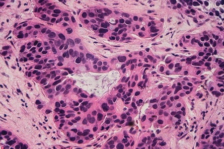 Image: The AI system uses dual-resolution image analysis to identify breast cancer with greater precision than conventional AI tools (Photo courtesy of Shutterstock)