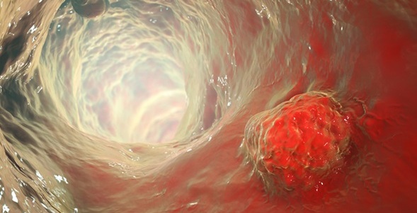 Image: The updated blood test has shown improved accuracy for early colorectal cancer detection (Photo courtesy of 123RF)