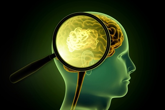 Image: Researchers have identified a previously unrecognized molecular subgroup of meningiomas (photo courtesy of Adobe Stock) Image: Researchers have identified a previously unrecognized molecular subgroup of meningiomas (photo courtesy of Adobe Stock)