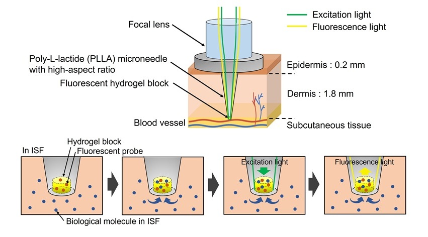 Image: The biodegradable microneedle device analyzes glucose in interstitial fluid without requiring traditional blood sampling (Fukuhara, M. et al., J Mater Chem B (2025). DOI: 10.1039/D5TB00385G)