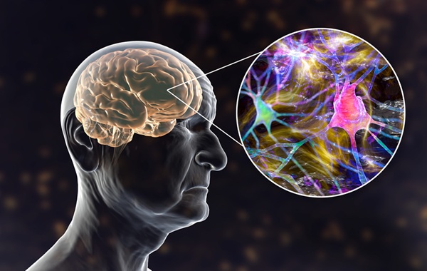 Image: pTau, a key Alzheimer’s biomarker, is also elevated in systemic amyloidosis affecting the heart and kidneys (Photo courtesy of 123RF)