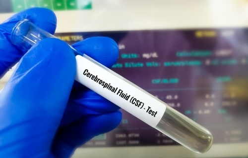 Image: DOPA decarboxylase concentrations in CSF can help differentiate Lewy body dementia from Alzheimer’s Disease