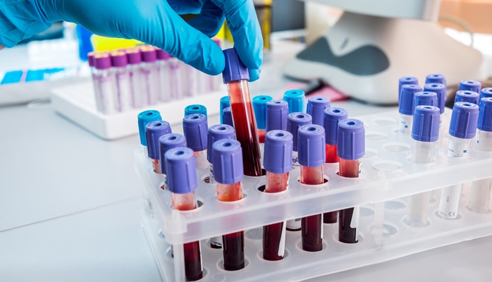 Image: The method that profiles DNA methylation in cell-free DNA from a single blood sample to detect disease signals system-wide (photo courtesy of Shutterstock)