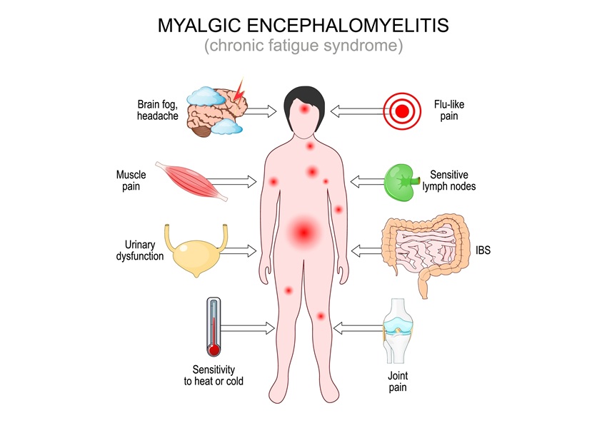 Image: Myalgic encephalomyelitis (ME) presents with heterogeneous, multisystem symptoms and post-exertional malaise, with overlap with conditions like fibromyalgia complicating diagnosis (photo courtesy of Shutterstock)