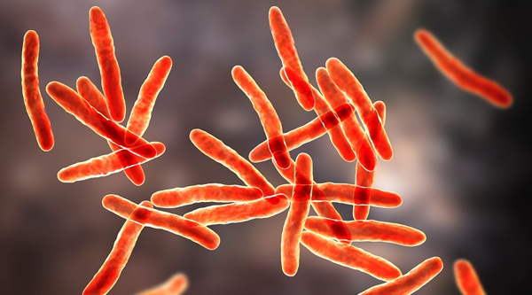 Image: Tuberculosis is a leading cause of death among people living with HIV, yet hospital diagnosis remains difficult because symptoms are often non-specific and many patients cannot produce sputum (image credit:123RF)