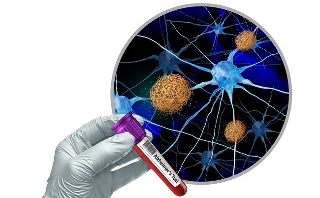 Image: The addition of pTau 217 complements blood-based approaches for clinical decision-making in neurology workflows. The fully automated format supports scalability on the LUMIPULSE G platform (photo courtesty of Shutterstock)