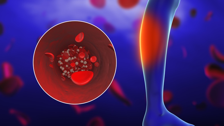 Image: Peripheral artery disease occurs when plaque partially or completely blocks arteries in the legs, arms, or pelvis, with limb loss among its serious complications (Photo courtesy of iStock)