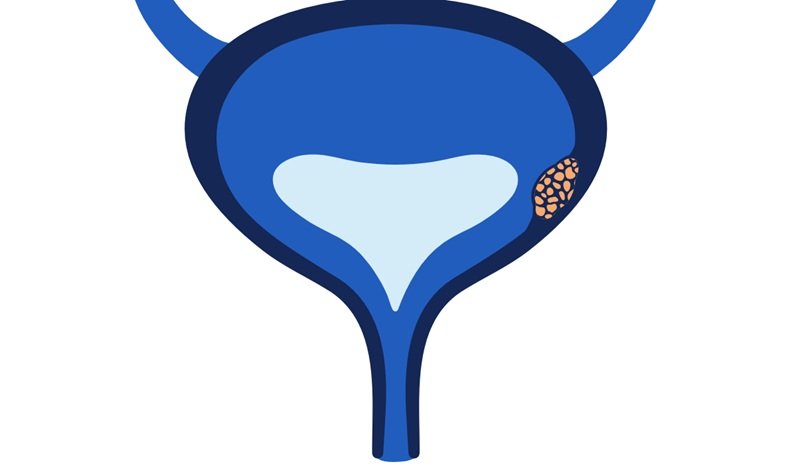Image: TrueMRD uses a whole-genome, tumor-informed approach that analyzes patient-specific tumor variants across the entire genome in every sample tested (photo courtesy of Veracyte)
