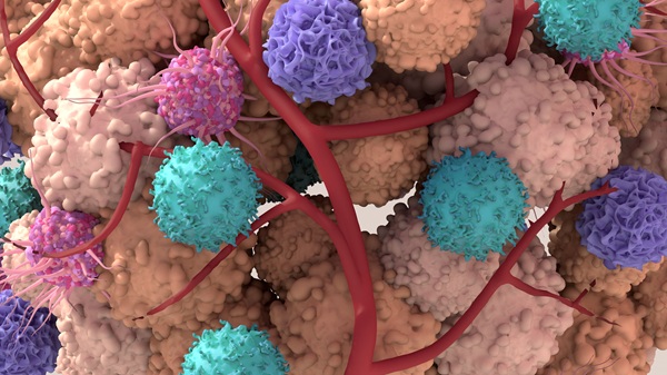 Image: New findings indicate that clonal hematopoiesis, an established prognostic factor in blood cancers, is associated with worse survival in patients with solid tumors (image credit: Adobe Stock)