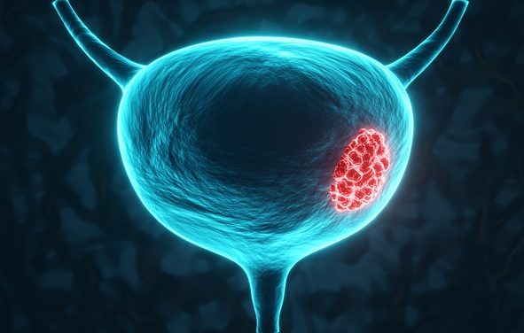 Image: The integrated multi-omics approach may help identify bladder cancer patients likely to respond to BCG and those needing alternative or intensified treatment (image credit: iStock)