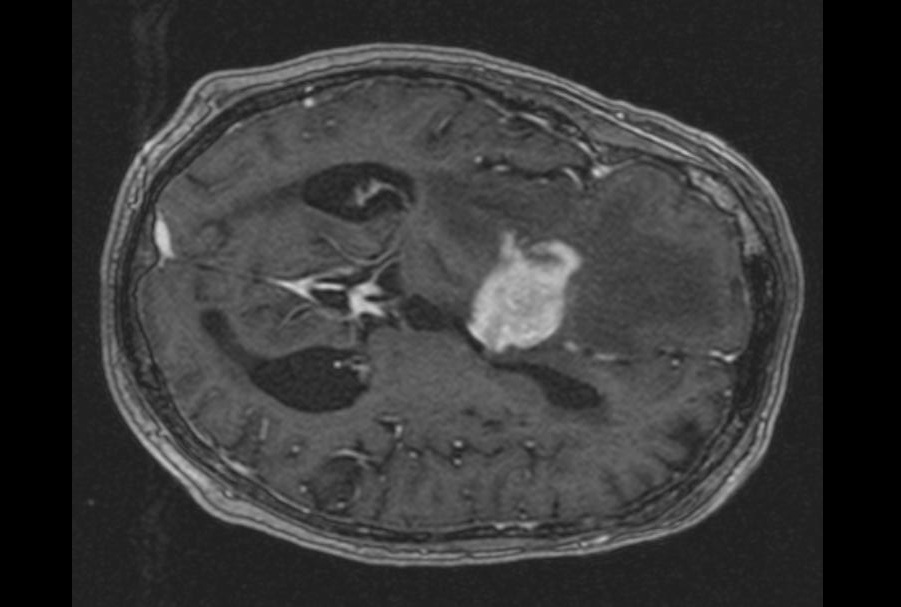 Image: Physicians currently use the Demicco score, based on patient age, tumor size, and microscopic appearance, to estimate SFT aggressiveness, but this approach can still leave uncertainty about which patients need closer surveillance. New findings show that specific genetic fusion patterns may add precision by helping identify SFTs more likely to recur or spread. Thought for a couple of seconds  Physicians use the Demicco score to estimate SFT aggressiveness, but uncertainty remains about which patients need closer surveillance. New findings suggest genetic fusion patterns may help identify SFTs more likely to recur or spread.  shorten a bit more  Physicians use the Demicco score to estimate SFT aggressiveness, but uncertainty remains. New findings suggest genetic fusion patterns may help identify SFTs more likely to recur or spread.  the findings suggest that HAVCR1 could enable earlier diagnosis, reduce the need for multiple invasive biopsies, and improve longitudinal assessment, including treatment monitoring and relapse detection, in PCNSL and PVRL.   The findings suggest that HAVCR1 could enable earlier diagnosis, reduce repeated invasive biopsies, and improve longitudinal assessment, including treatment monitoring and relapse detection, in PCNSL and PVRL.  Primary central nervous system lymphoma (PCNSL) is a rare malignancy of the brain, spinal cord, and eyes with delayed diagnosis and poor outcomes. Current fluid-based testing using interleukin measurements reaches only about 80–90% accuracy,  Primary central nervous system lymphoma (PCNSL) is a rare malignancy of the brain, spinal cord, and eyes that is often diagnosed late and associated with poor outcomes (