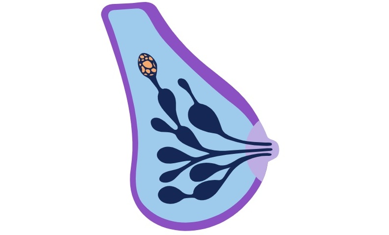 Image: The Prosigna test provides clinicians and patients with genomic insights to help make more informed breast cancer treatment decisions (Photo courtesy of Veracyte)