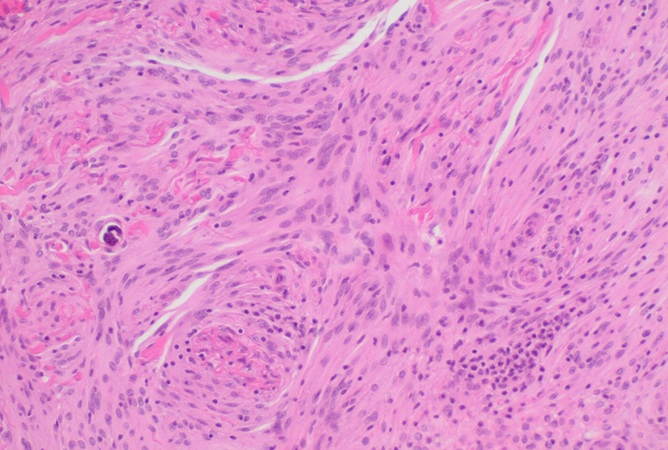 Image: Findings demonstrate that AI can help classify meningiomas by extracting molecular and prognostic information from standard H&E slides already used in routine care. (Image Credit: Mikael Häggström, M.D./Wikimedia Commons, CC0 1.0)