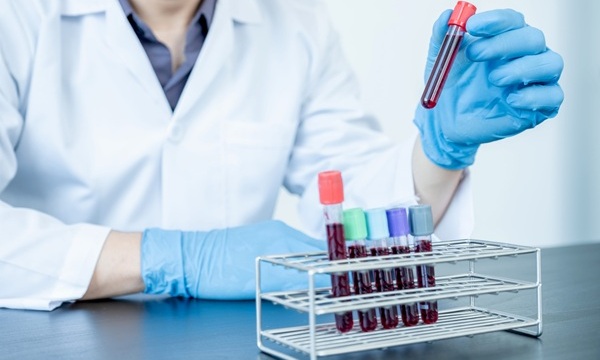 Image: Findings showed that the Stockholm3 blood test detected more clinically significant prostate cancers than PSA testing without increasing unnecessary testing (Image credit: 123RF) Image: Findings showed that the Stockholm3 blood test detected more clinically significant prostate cancers than PSA testing without increasing unnecessary testing (Image credit: 123RF)