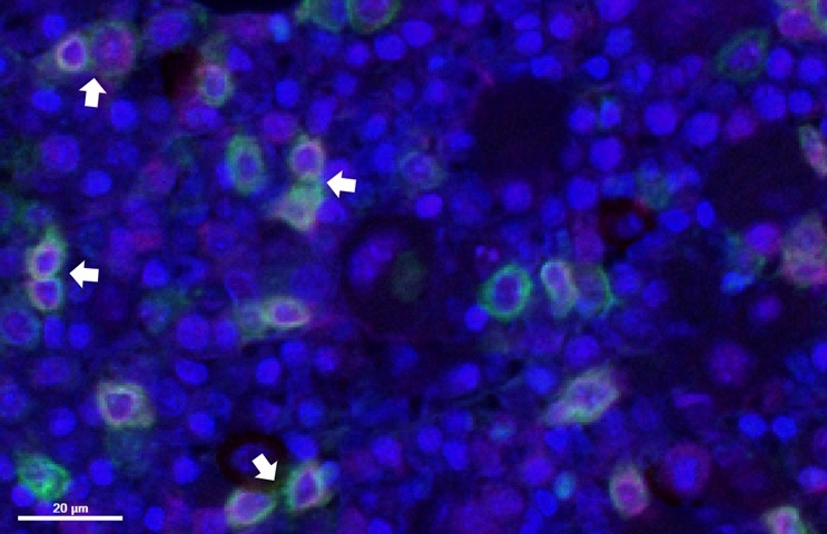 Image: Atypical clustering of myeloid progenitor cells called myeloblasts (white arrows), defined by their co-expression of CD34 (magenta) and CD117 (green), in a bone marrow biopsy tissue from a patient with MDS. (Image Credit: Dr. Sanjay Patel) Image: Atypical clustering of myeloid progenitor cells called myeloblasts (white arrows), defined by their co-expression of CD34 (magenta) and CD117 (green), in a bone marrow biopsy tissue from a patient with MDS. (Image Credit: Dr. Sanjay Patel)