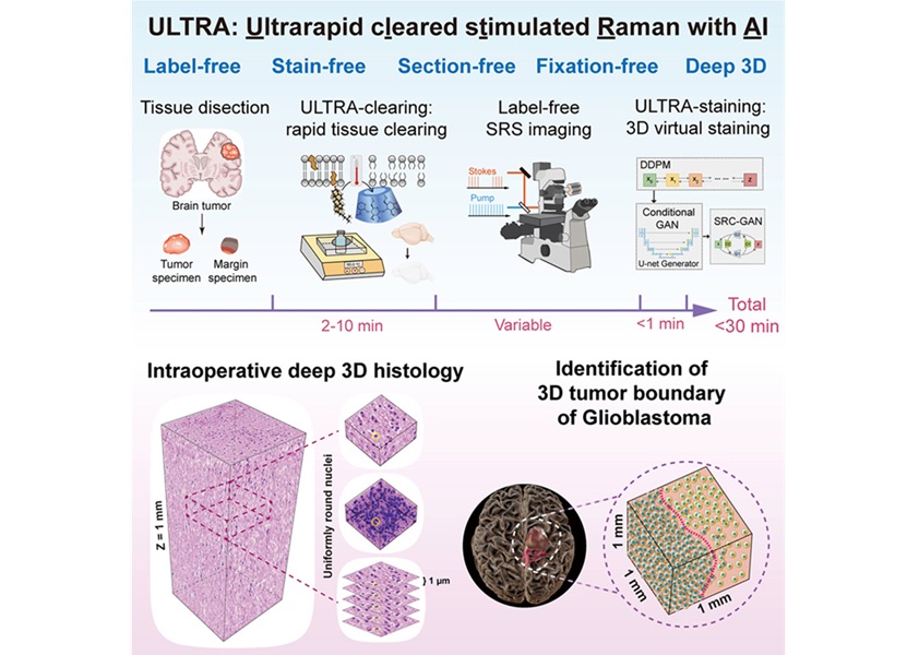 Image: Graphical Abstract (Zhijie Liu et al, Ultrarapid deep 3D histology enables intraoperative mapping of glioma infiltration, Cell (2026). DOI: 10.1016/j.cell.2026.07.026)