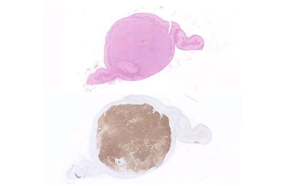 Image: Adrenal gland tumor stained with hematoxylin and eosin (top) and CYP11B2 (bottom) (Photo courtesy of Christofer Juhlin)