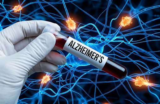 Image: Alzheimer’s pathology can start 15 to 20 years before symptoms, and validated tools that reach patients earlier help pave the way for earlier detection. (Image Credit: Adobe Stock)
