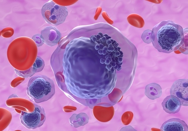 Image: Acute myeloid leukemia is an aggressive blood cancer in which relapse remains a major challenge, making MRD detection critical for risk assessment and treatment planning (Image Credit: Shutterstock)