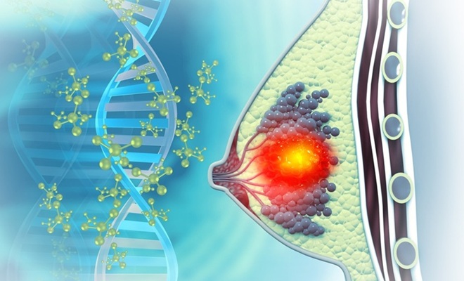 Image: The model combines digitized tumor histopathology, clinical variables, and a 42-gene molecular panel using AI to generate a unified recurrence risk prediction (Image Credit: Shutterstock)