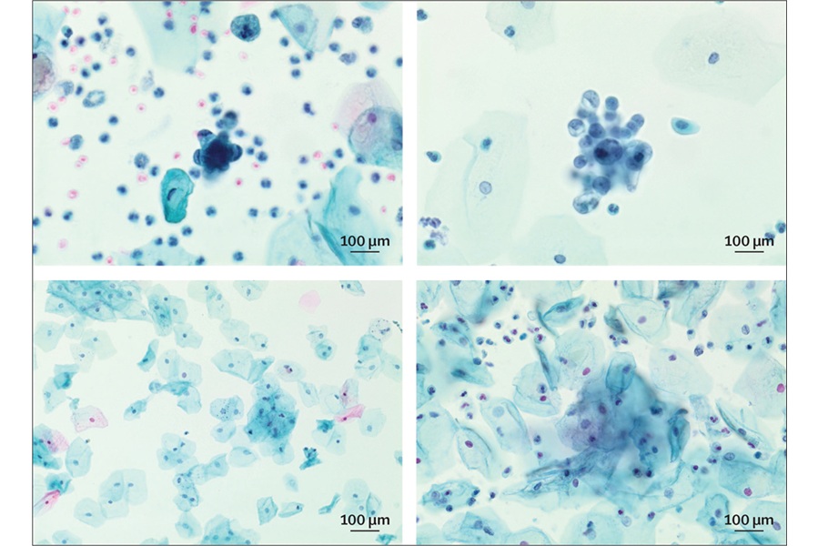 Image: Vaginal and urine samples showing endometrial cancer (true positive case; upper row) and no malignant cells (true negative case; lower row). (Jones ER, Narine N, O\'Flynn H, et al. The Lancet Obstetrics, Gynaecology, & Women\'s Health (2026). DOI:10.1016/S3050-5038(26)00222-0.)