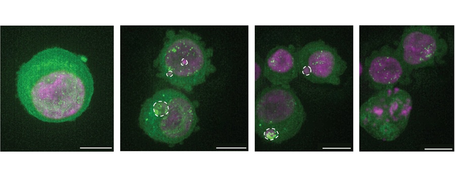 Image: This sequence of images shows a cell containing micronuclei, which is undergoing cell death. Chromatin is stained in pink, and ring-shaped DNA in fluorescent green. The white dotted lines mark regions with micronuclei. (Photo courtesy of Aditi Gnanasekar, Stanford University) Image: This sequence of images shows a cell containing micronuclei, which is undergoing cell death. Chromatin is stained in pink, and ring-shaped DNA in fluorescent green. The white dotted lines mark regions with micronuclei. (Photo courtesy of Aditi Gnanasekar, Stanford University)