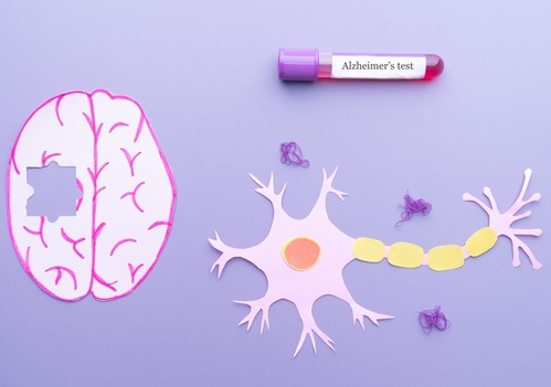 Image: The test identifies individuals more likely to have elevated brain amyloid, with PET used for confirmation (Image Credit: Adobe Stock)