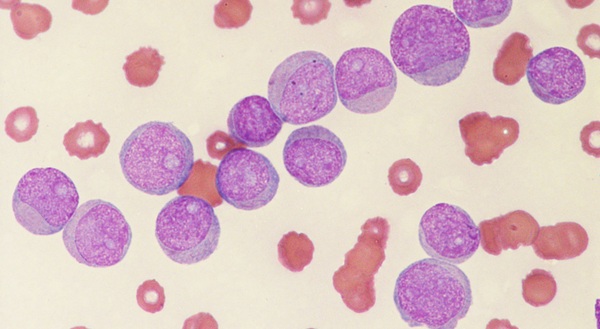 Image: Acute myeloid leukemia is the first of several disease areas the collaborators plan to pursue together as part of efforts to advance precision diagnostics (Image Credit: Adobe Stock)