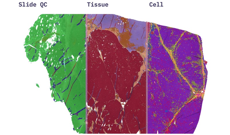 Image: HETA Quality Control identifies slide quality issues before analysis, while HETA Tumor Detect annotates tumor regions and flags slides likely to contain tumor during scanning. (Photo courtesy of Aignostics)