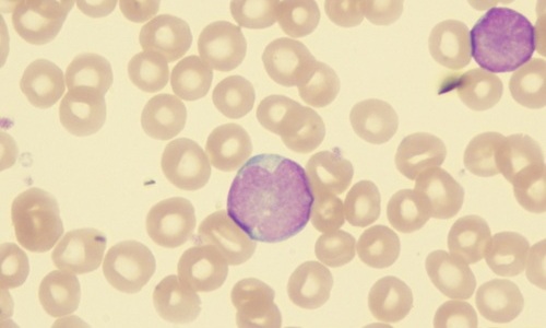 Image: Acute lymphoblastic leukemia in children and young people requires careful relapse risk assessment as treatment expands beyond standard chemotherapy. (Image Credit: Shutterstock)
