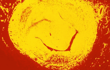 Image: Digitized light micrograph of a cross section of a blocked vein: a condition known as deep vein thrombosis (DVT) (Photo courtesy of CMSP / SPL).