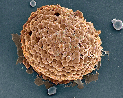 Image: Colored scanning electron micrograph (SEM) of a human mast cell (Photo courtesy of Steve Gschmeissner / SPL).