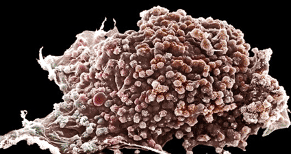 Image: A color-enhanced scanning electron microscope image of a cancer cell (Photo courtesy of D. Phillips / SPL).