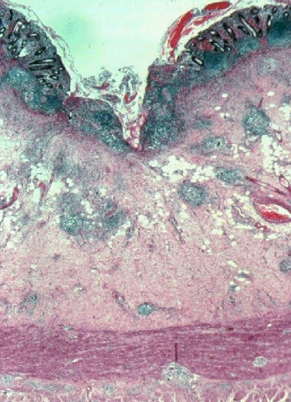 Image: Light micrograph of the human small intestine in Crohn’s disease (Photo courtesy of Biophoto Associates).