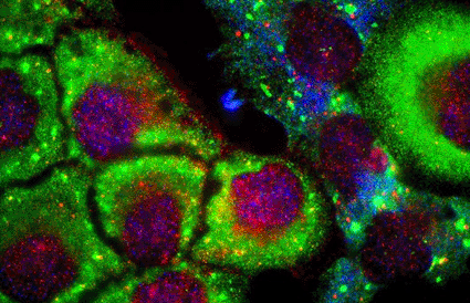 Image: Confocal light micrograph of prostate cancer cells, showing stress granules (green) that have accumulated in the cytoplasm due to oxidative stress (Photo courtesy of Nancy Kedersha / SPL).