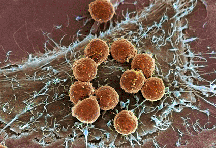 Image: Colored scanning electron micrograph (SEM) of T lymphocyte cells (orange) attached to a cancer cell (Photo courtesy of Steve Gschmeissner / SPL).
