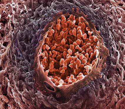 Image: Colored scanning electron micrograph (SEM) of a section through a small blood vessel in a cancer of the ovary (Photo courtesy of Steve Gschmeissner / SPL).