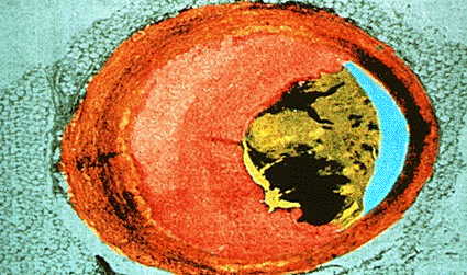 Image: Colored scanning electron micrograph (SEM) of a cross-section through a human coronary artery of the heart showing atherosclerosis (Photo courtesy of GJLP / SPL).